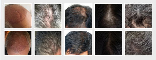 How Does AnaGain™ Work To Help Treat Hair Loss?